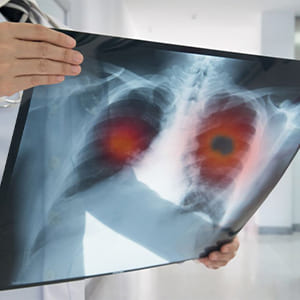 deteccion-oportuna-del-cancer